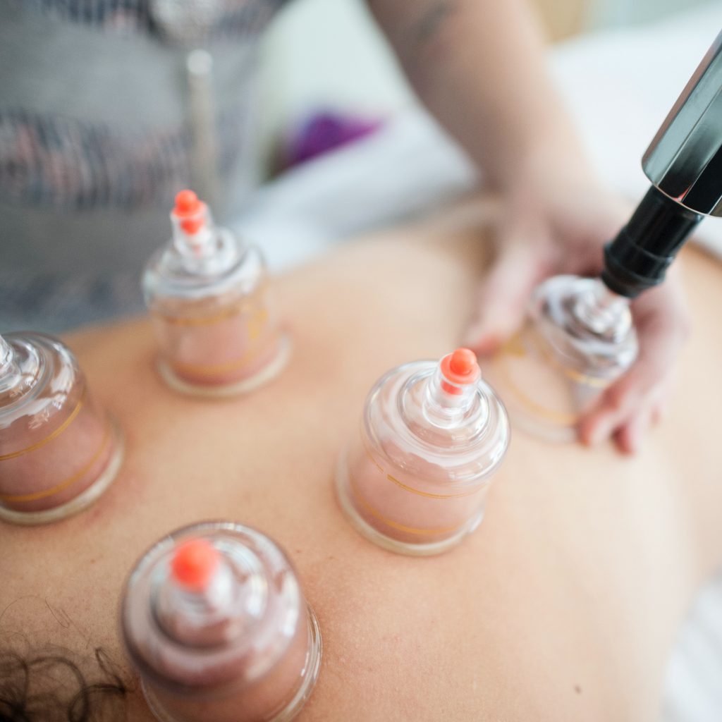 Reduce cellulite for summer with dry cupping